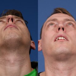 Jesse E Smith, MD, FACS - Rhinoplasty Before & After #13