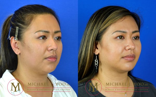 MICHAEL J YOO, MD - Updated February 2025 - 420 Photos & 94 Reviews ...