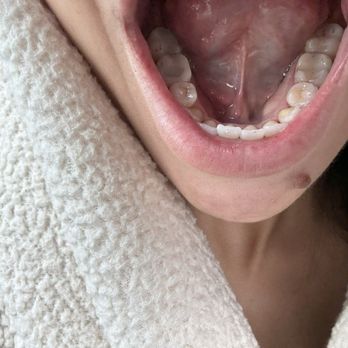 Signature Smiles Dental - After I got my fillings and cleaning done - General Dentistry Near Me - Riverside, California Signature Smiles Dental - After I got my fillings and cleaning done - General Dentistry Near Me - Riverside, California