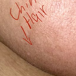 After wax. I have pcos so I'm really insecure about posting this but because of my chin is why I asked for a full face wax ): After wax. I have pcos so I'm really insecure about posting this but because of my chin is why I asked for a full face wax ):
