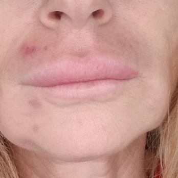 Charles S. Lee, MD - Before. Tried to fix jawline with fillers. - Cosmetic Surgeons Near Me - Beverly Hills, California Charles S. Lee, MD - Before. Tried to fix jawline with fillers. - Cosmetic Surgeons Near Me - Beverly Hills, California