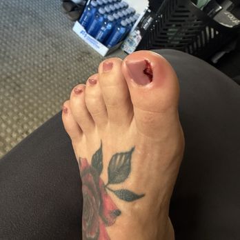Redberry Nails And Spa - Infected toe-do not go to Redberry salon - Nail Salons Near Me - San Jose, California Redberry Nails And Spa - Infected toe-do not go to Redberry salon - Nail Salons Near Me - San Jose, California