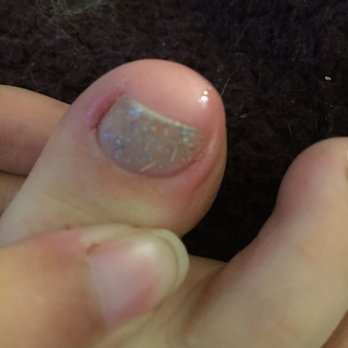 Q Beauty Spa - My toe after a pedicure. Swollen, red, hurts, and looks horrible - Massage Near Me - Hayward, California Q Beauty Spa - My toe after a pedicure. Swollen, red, hurts, and looks horrible - Massage Near Me - Hayward, California