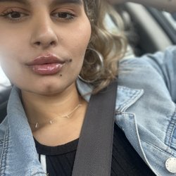 VIP Aesthetic Center - Juvederm lip fillers