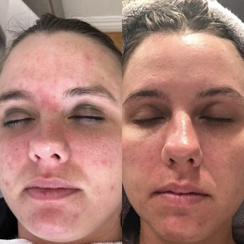 The Peel Connection - Skin Care Near Me - Beverly Hills, California