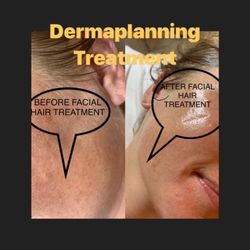 Facials By Vanessa CT - Dermaplaning - before and After