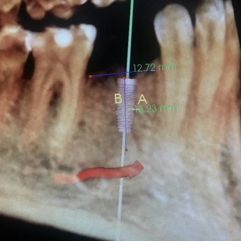 Manhattan Dental - 3D Xrays the top in technology are free of charge for Our Implant patients. - Orthodontists Near Me - Pearland, Texas
