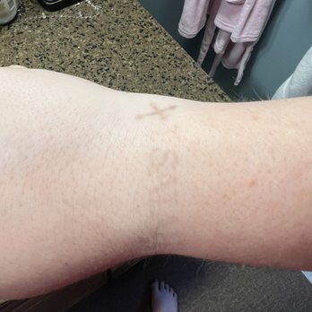 Renewal Laser Tattoo Removal - Wrist tattoo - Tattoo Removal Near Me - Lake Worth, Florida