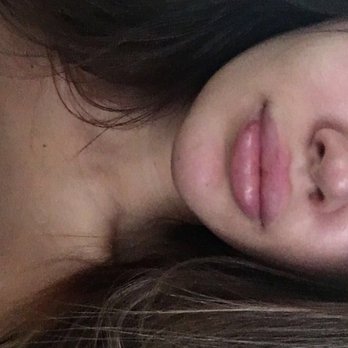 BOTOX Cosmetic LABB - My lips the second day, small bruise and swollen but looking great!! Sooooo much better already! - Medical Spas Near Me - Miami Beach, Florida BOTOX Cosmetic LABB - My lips the second day, small bruise and swollen but looking great!! Sooooo much better already! - Medical Spas Near Me - Miami Beach, Florida