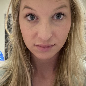 ZO Skin Centre - After bad Botox from another company - Skin Care Near Me - Dallas, Texas ZO Skin Centre - After bad Botox from another company - Skin Care Near Me - Dallas, Texas