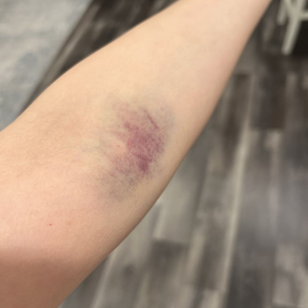 very Painful very Painful