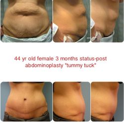 Antell Plastic Surgery: David Antell, DO, FACS - Tummy Tuck
