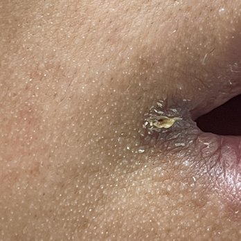 Gold Coast Dental Orange - Looks disgusting and now I will have a dark, gross looking scar on the corner of my moth - Orthodontists Near Me - Orange, California