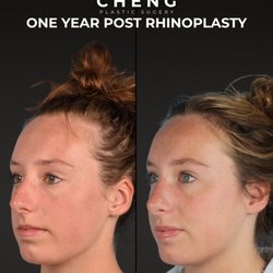 Cheng Plastic Surgery - 1 Year Post Rhinoplasty