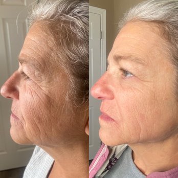 Monarch Beauty Studios - Before and after plasma fibroblast - Skin Care Near Me - Peyton, Colorado
