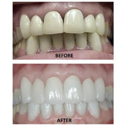 Kent M Mattison, DMD FAGD - Snellville Dental Group - Before and After: Veneers