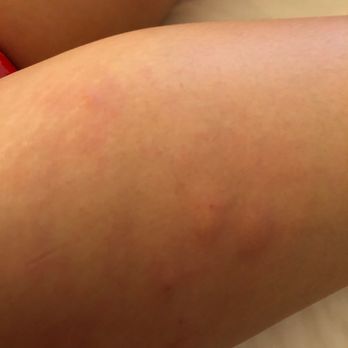 Woodbine Hotel And Suites - Bed bugs? Insects? Idk, i got outta there - Hotels Near Me - Toronto, Ontario Woodbine Hotel And Suites - Bed bugs? Insects? Idk, i got outta there - Hotels Near Me - Toronto, Ontario