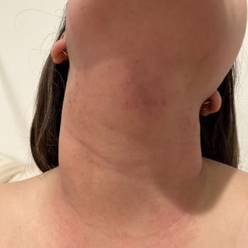 ZO Skin Centre Beverly Hills - Day 3 after facial: Marks and scabs all over my neck - Dermatologists Near Me - Beverly Hills, California ZO Skin Centre Beverly Hills - Day 3 after facial: Marks and scabs all over my neck - Dermatologists Near Me - Beverly Hills, California