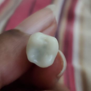 Xiao Dental - Broken tooth - General Dentistry Near Me - Livermore, California Xiao Dental - Broken tooth - General Dentistry Near Me - Livermore, California