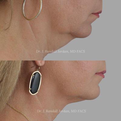 Neck Lift and AccuLift RF - Neck Lift for Men: Cervicoplasty
Most men who visit our practice express a desire to restore a youthful look that complements a masculine aesthetic. One of the most common procedures men desire is direct neck lift surgery, also known as cervicoplasty.

Men undergo a neck lift to eliminate excess fat and tighten the muscles that contribute to sagging, loose skin on their necks. It can also help create a stronger-looking jawline and a better-defined chin. Enhance your facial features while highlighting your masculinity with this facial plastic surgery procedure specifically tailored for men.

A direct neck lift helps men achieve a better-contoured neck and jawline. The end result will be a more proportioned face, a more defined jaw, sharper facial lines, and a sleeker chin and neck junction.

During a direct neck lift:

We remove the excess fat that contributes to a double chin.
We excise excess skin in the midline.
The muscle under the skin is tightened.
The incision is closed with sutures.
We use special dressings to apply pressure and aid in healing.
There will be a scar in the midline of the neck that typically heals well over time.

Dr. Jordan may recommend other cosmetic services and procedures during your consultation, depending on the overall look you want to achieve. For example, many men who undergo a neck lift also choose to get dermal fillers or BOTOX® injections to help achieve a fully refreshed look.

AccuLift RF: Skin Tightening + Liposuction for the Neck

How does AccuLift RF work?
For more than two decades, Faces has brought some of the latest aesthetic technology to the Jackson, MS, area. We love being able to use technology for patients who would rather skip invasive facial plastic surgery procedures or simply don't have the time for a longer recovery. Acculift RF combines liposuction with the radiofrequency energy of InMode’s Embrace RF device to tighten skin and remove fat at the same time.

Dr. Jordan makes small openings in the targeted areas of the neck during an AccuLift RF procedure. These small openings are no bigger than the size of a needle (about 2 mm). Initially, we perform liposuction to remove excess fat, and then insert the RF probe (called the FaceTite) into these same small openings to heat the skin. AccuLift RF ideally sculpts a patient's neck contours, while the heating process also produces skin-tightening effects. The healing process boosts collagen production to promote ongoing rejuvenation.

What are the benefits of the AccuLift RF procedure?
The convenience and cost of AccuLift RF make it an appealing cosmetic procedure. Typically, the in-office procedure AccuLift RF takes about 30 minutes to an hour to complete. While AccuLift RF will not produce the same results as a facelift or neck lift, it can be a quick and effective way to look years younger and dramatically reduce excess fat in the neck area.

Generally, both men and women use AccuLift RF to enhance their appearance.

Fatty neck
Double chin
Loose skin under the chin
AccuLift RF also produces very little bruising and swelling and has a mild recovery period. Most patients can return to their normal day-to-day routine within a few days. While the benefits of AccuLift RF are long-lasting, the ultimate results may take months to recognize.