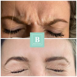 Beautytox Aesthetics - Botox done to her frown line