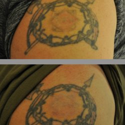 Beloved Laser Tattoo Removal - He had started the removal process elsewhere and we finished it (Just the center).