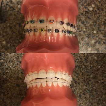 Shelliann Kawamoto, DDS - Choice of silver or plain/white braces. Silver one of course is cheaper. - Orthodontists Near Me - Honolulu, Hawaii Shelliann Kawamoto, DDS - Choice of silver or plain/white braces. Silver one of course is cheaper. - Orthodontists Near Me - Honolulu, Hawaii