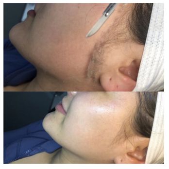 Wax & Wine Salon - Before & After Dermaplaning - Waxing Near Me - Dallas, Texas Wax & Wine Salon - Before & After Dermaplaning - Waxing Near Me - Dallas, Texas