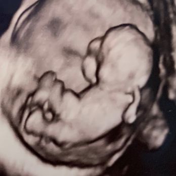 J Rophe Medical - 10weeks 4days - 3-D - Crisis Pregnancy Centers Near Me - Eureka, California