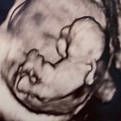 J Rophe Medical - 10weeks 4days - 3-D