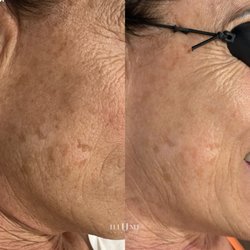 Illume Skin Spa - IPL Before and After
