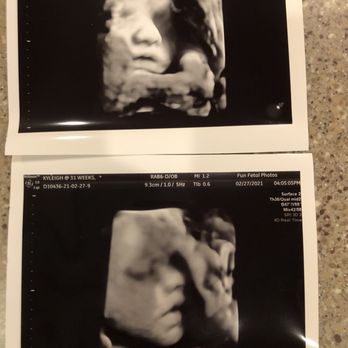 Fun Fetal Photos - 31 weeks - Diagnostic Imaging Near Me - Hampton, Virginia Fun Fetal Photos - 31 weeks - Diagnostic Imaging Near Me - Hampton, Virginia