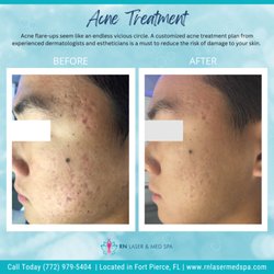 RN Laser & Med Spa - Acne Treatment