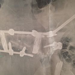 Joseph R O'Brien, MD - Broken fusion, it just collapsed. Two screws abutting nerves.
