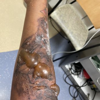 Zapatat - Tattoo Removal Near Me - Arlington, Virginia