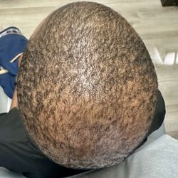 Arizona Aesthetics - 32 year old 9 months after Stem Cell Hair Restoration.