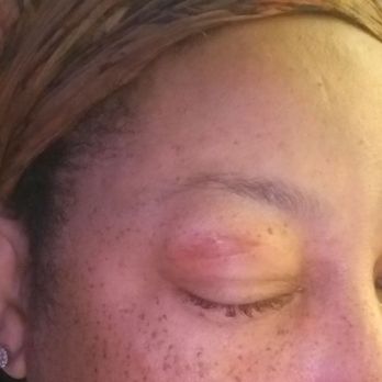 Gaia Nails - Swollen painful burn from eyebrow wax - Nail Salons Near Me - Walnut Creek, California