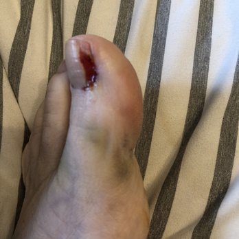Best Foot Forward - Wrong side of toenail removed on the right and bruising from the numbing shots - Podiatrists Near Me - Festus, Missouri