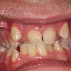 Kubicki Donald J, DDS - Crowding
Cross-bite
Under-bite