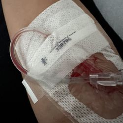 Reading Hospital - Tower Health - Days old IV leaking blood not changed timely.