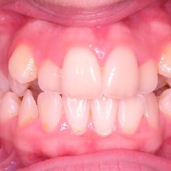 Wang Orthodontics LLC - Wang Orthodontic Patient "B" Before