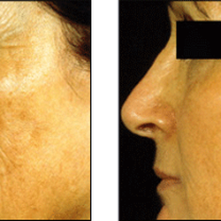 Advanced Dermatology - Fraxel Laser Treatment