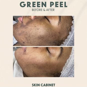 Skin Cabinet - Green Herbal Peel - this is after 3 sessions. - Skin Care Near Me - Denton, Texas Skin Cabinet - Green Herbal Peel - this is after 3 sessions. - Skin Care Near Me - Denton, Texas