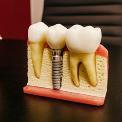 Premier Dental - Are you looking for options to help with missing teeth? Premier Dental can improve your smile and confidence with implants.