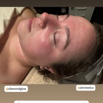 Elysian Rose Aesthetics & Wellness - Results after diamond glow facial - Massage Therapy Near Me - Encinitas, California Elysian Rose Aesthetics & Wellness - Results after diamond glow facial - Massage Therapy Near Me - Encinitas, California