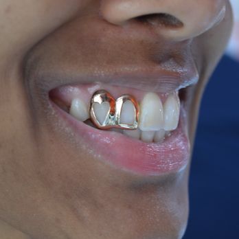 Baltimore Gold Fronts - Jewelry Near Me - Baltimore, Maryland Baltimore Gold Fronts - Jewelry Near Me - Baltimore, Maryland