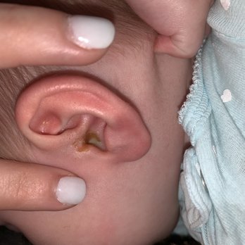UW VMC Maple Valley Clinic - Pic a day after being told "her ear looks great!"- ‍ - Urgent Care Near Me - Maple Valley, Washington