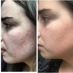 The Beauty PA - Microneedling