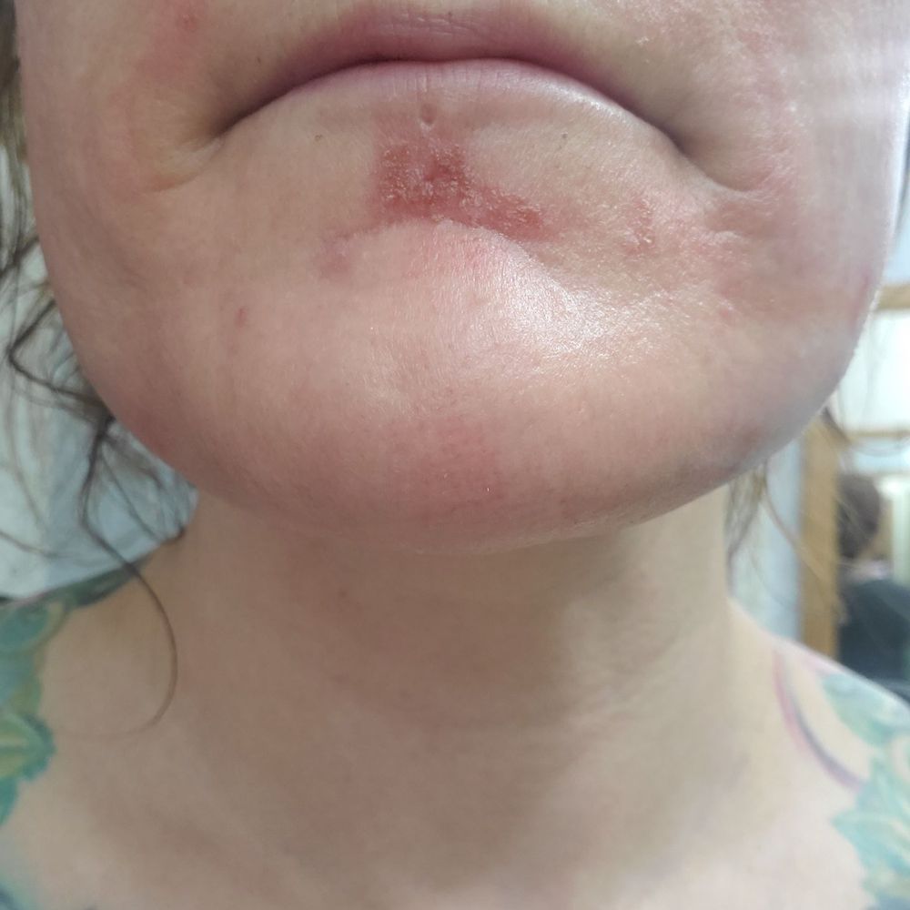 Elite Medspa - Weeks after Pixel procedure by Blake. My upper lip was burned too but clearly not as badly. - Medical Spas Near Me - Scottsdale, Arizona