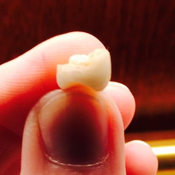 Willow Creek Dental - Another great side pic of my $1246+ crown. - Cosmetic Dentists Near Me - Lone Tree, Colorado Willow Creek Dental - Another great side pic of my $1246+ crown. - Cosmetic Dentists Near Me - Lone Tree, Colorado